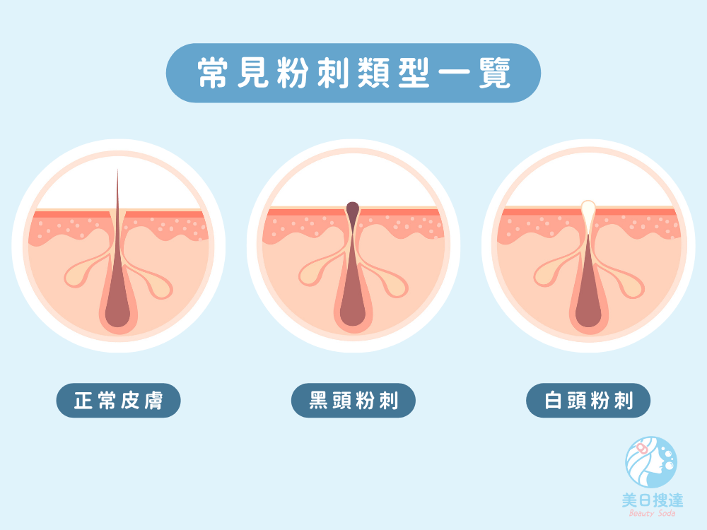 黑頭粉刺白頭粉刺